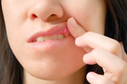 Ayurvedic Treatments for Mouth Ulcers